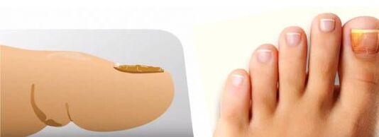 Hongos en las uñas de los pies