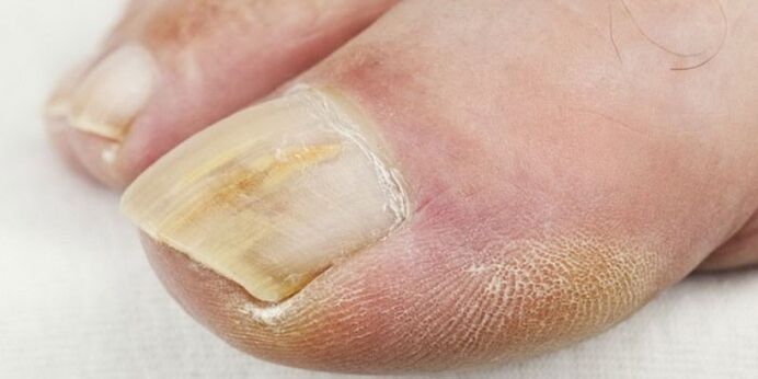 Síntomas de hongos en las uñas de los pies