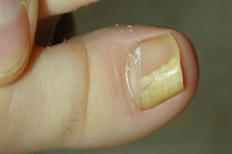 Síntomas de un hongo en el dedo gordo del pie Foto 1