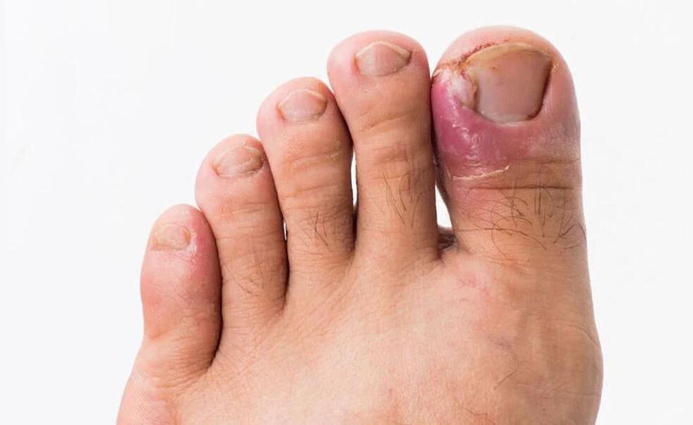 hongos en los dedos de los pies