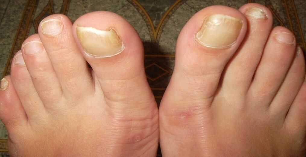 Primeras etapas de hongos en las uñas de los pies