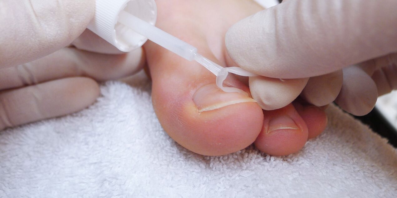 barniz médico contra hongos en las uñas