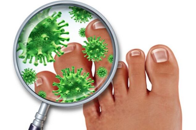 Infección por hongos en las uñas de los pies