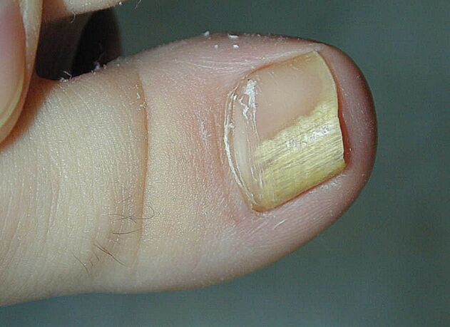 síntomas hongos en las uñas
