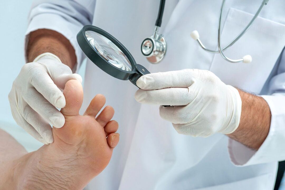 el doctor examina los pies con hongos