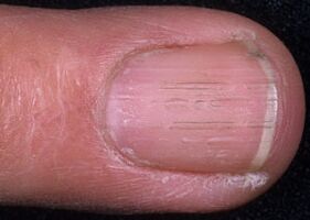 Signos de hongos en las uñas de los pies