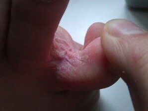 Lesiones en la piel entre los dedos de los pies con un hongo