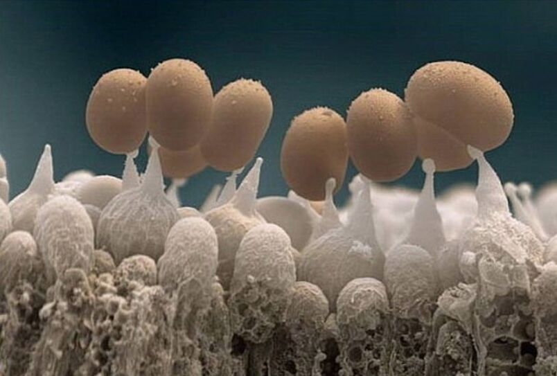 Hongos en las uñas de los pies bajo el microscopio