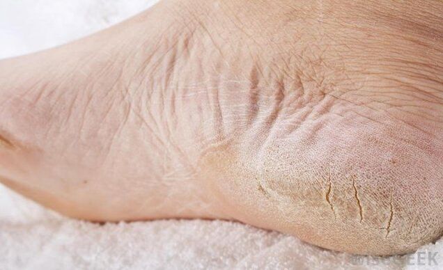 Los pies secos son un signo de infección por hongos