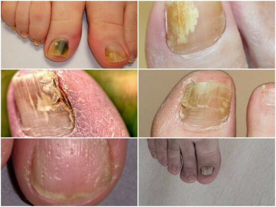 Síntomas de una infección por hongos en las uñas. 