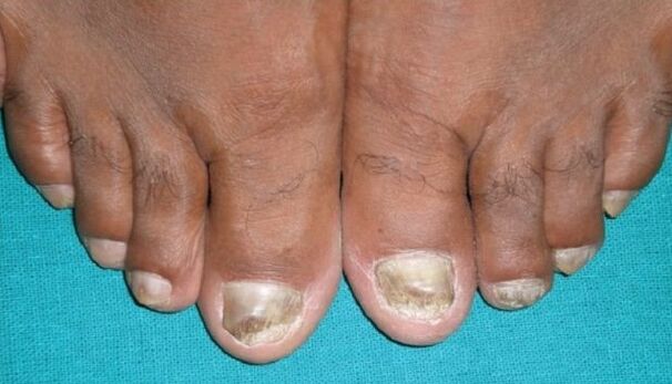 Champiñones en las uñas
