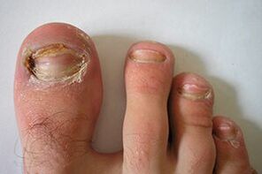 Champiñones en las uñas