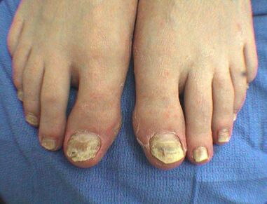Síntomas del hongo de las uñas
