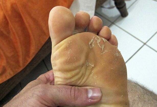 Hongo sobre la piel de las piernas