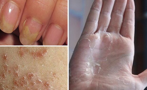 Puede cambiar la micosis a otras partes del cuerpo