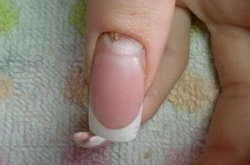 Síntomas de hongos en las uñas.