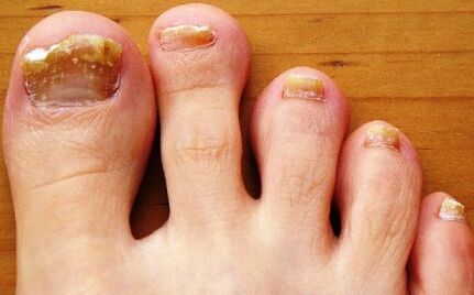 Uñas de los pies afectadas por hongos.