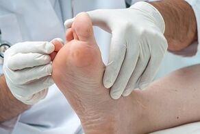 El médico examina los pies en busca de infecciones por hongos en los dedos.