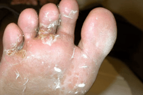 Hongos en dedos y pies.