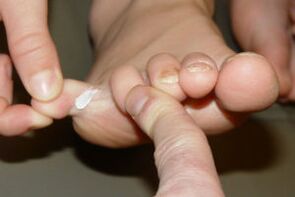 Hongos en los dedos de los pies