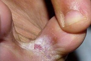 Síntomas de un hongo entre los dedos de los pies.