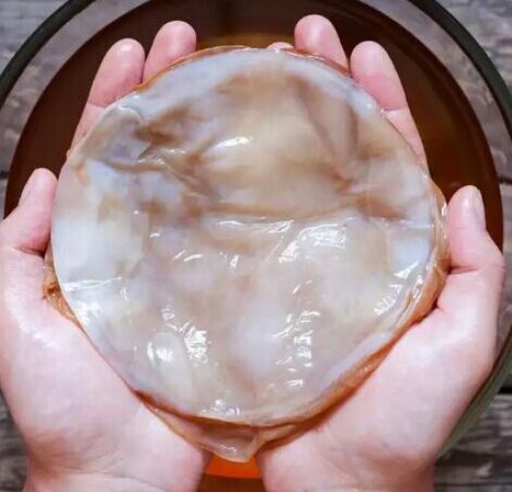 Hongos en las uñas kombucha