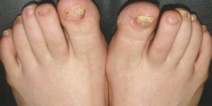 ¿Qué son los hongos en las uñas
